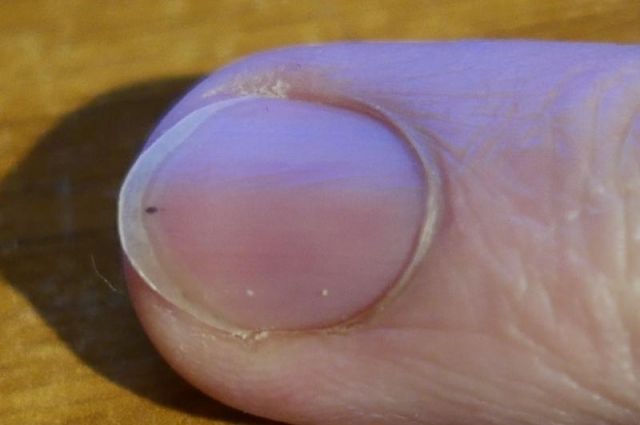 Псориаз ногтей: причины и лечение