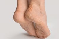 Чрезмерное удаление огрубевшей кожи на стопах вредно.